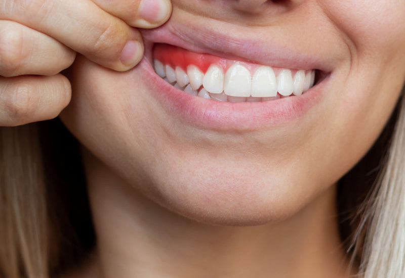 Soluția pentru sângerarea gingiilor.